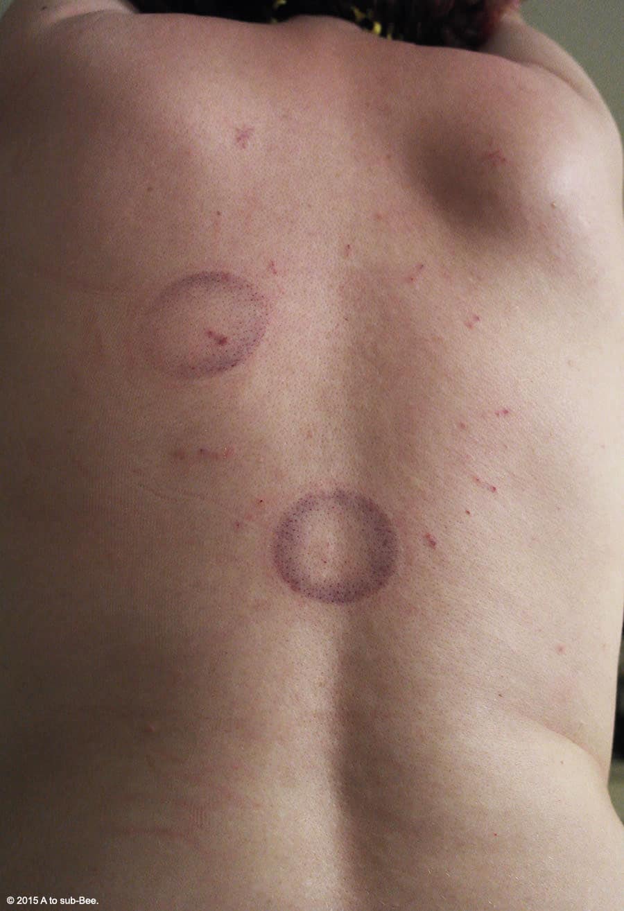 Bruises leaving a lasting impressuin after the fire cupping experience discussed last week