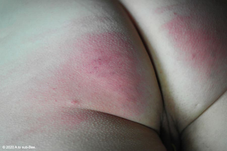 Bee's arse covered with red marks