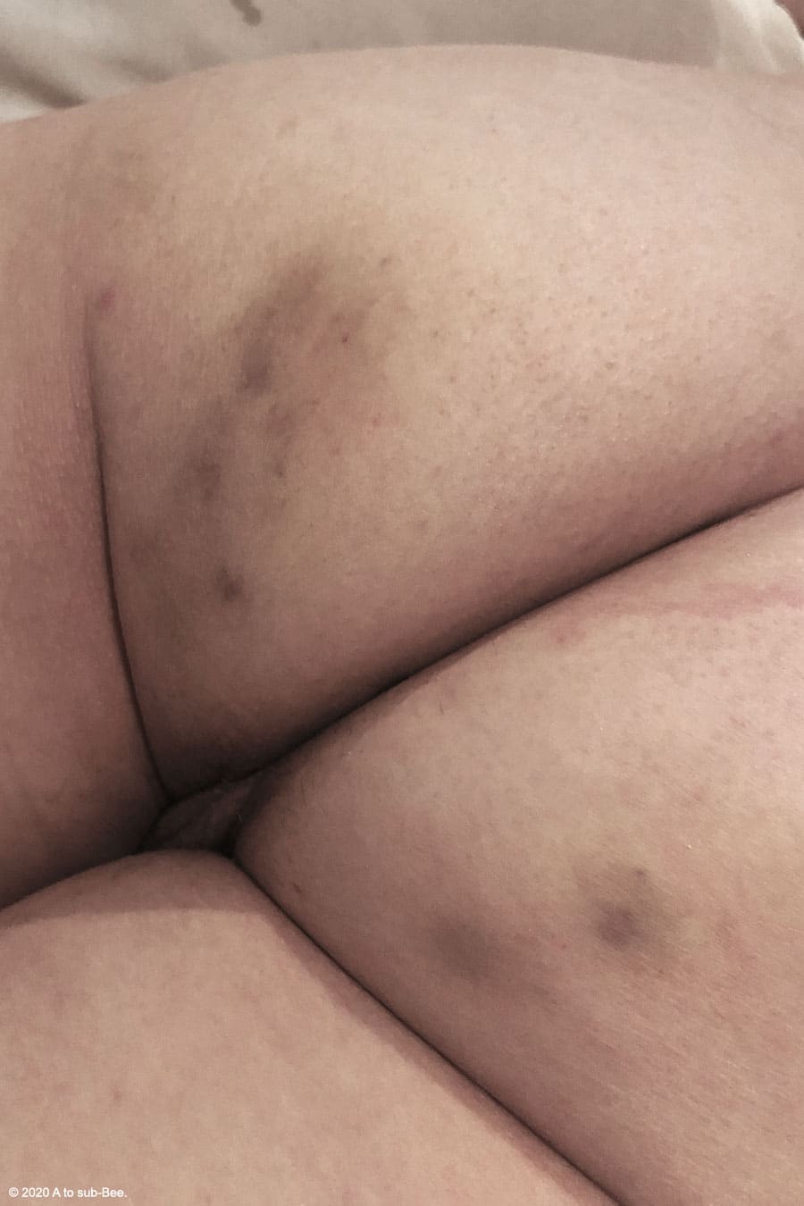 Bee's arse covered with bruises